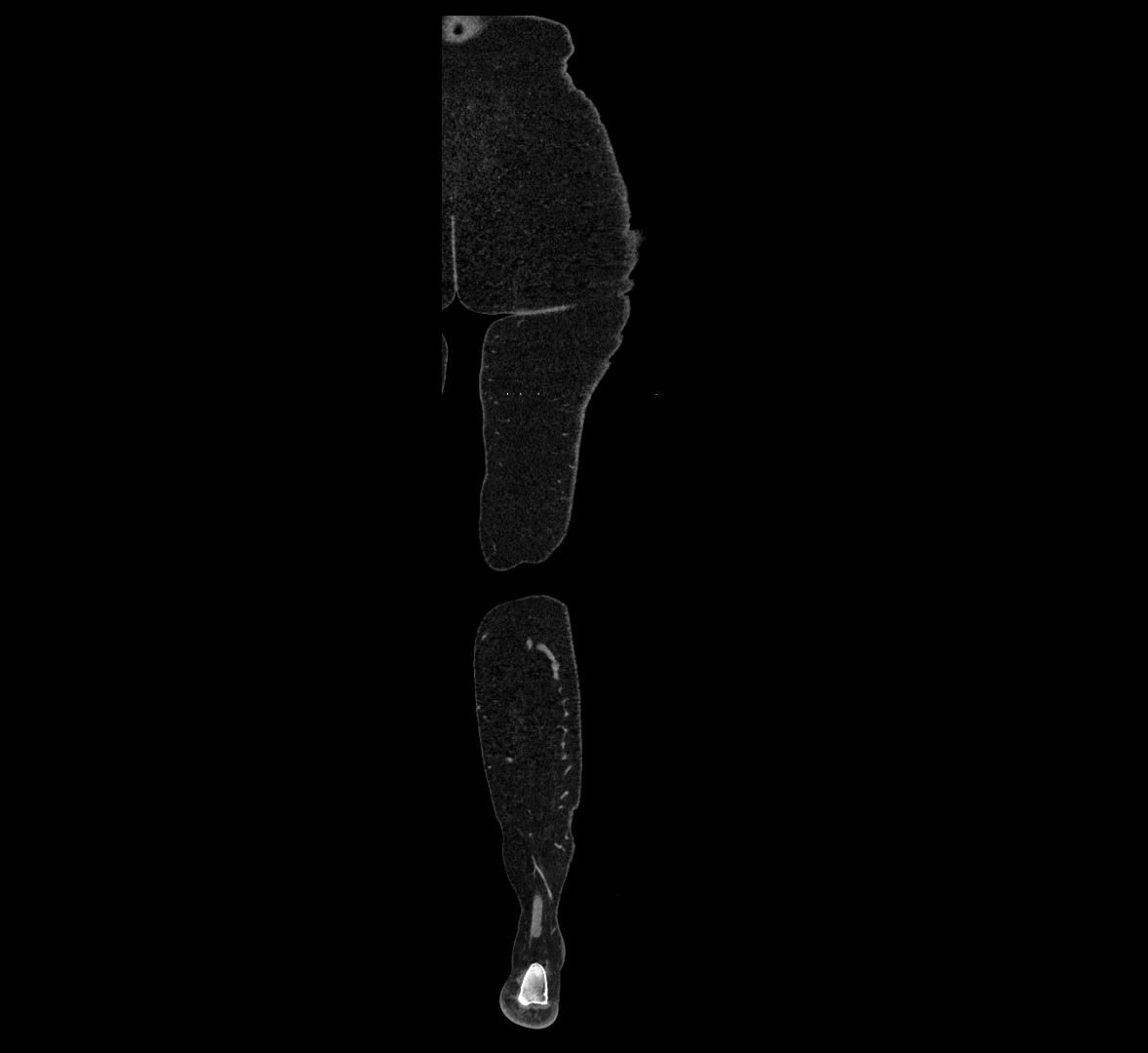 CTA lower limb coronal cross sectional anatomy labelled image _89 (2).webp